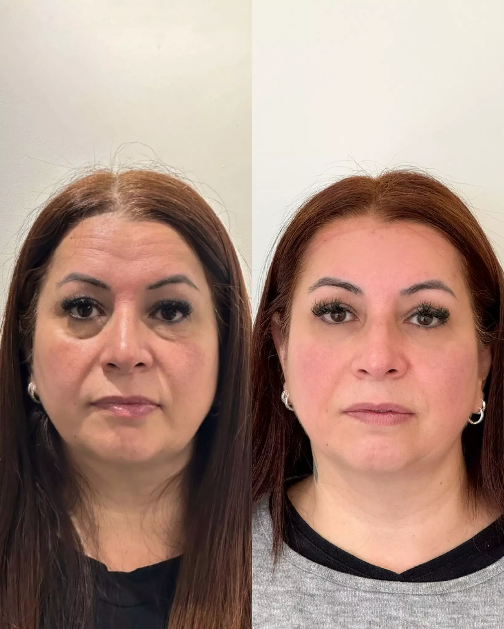 PREENCHIMENTO DE OLHEIRAS