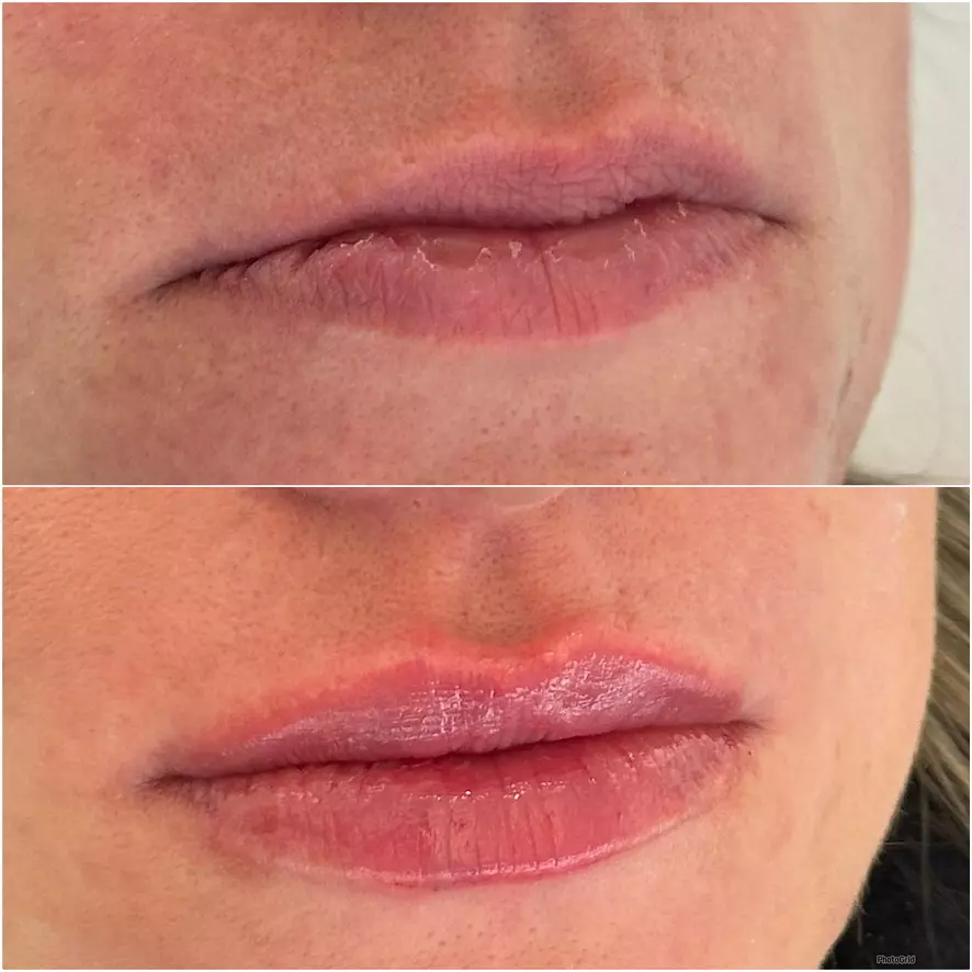 PREENCHIMENTO LABIAL